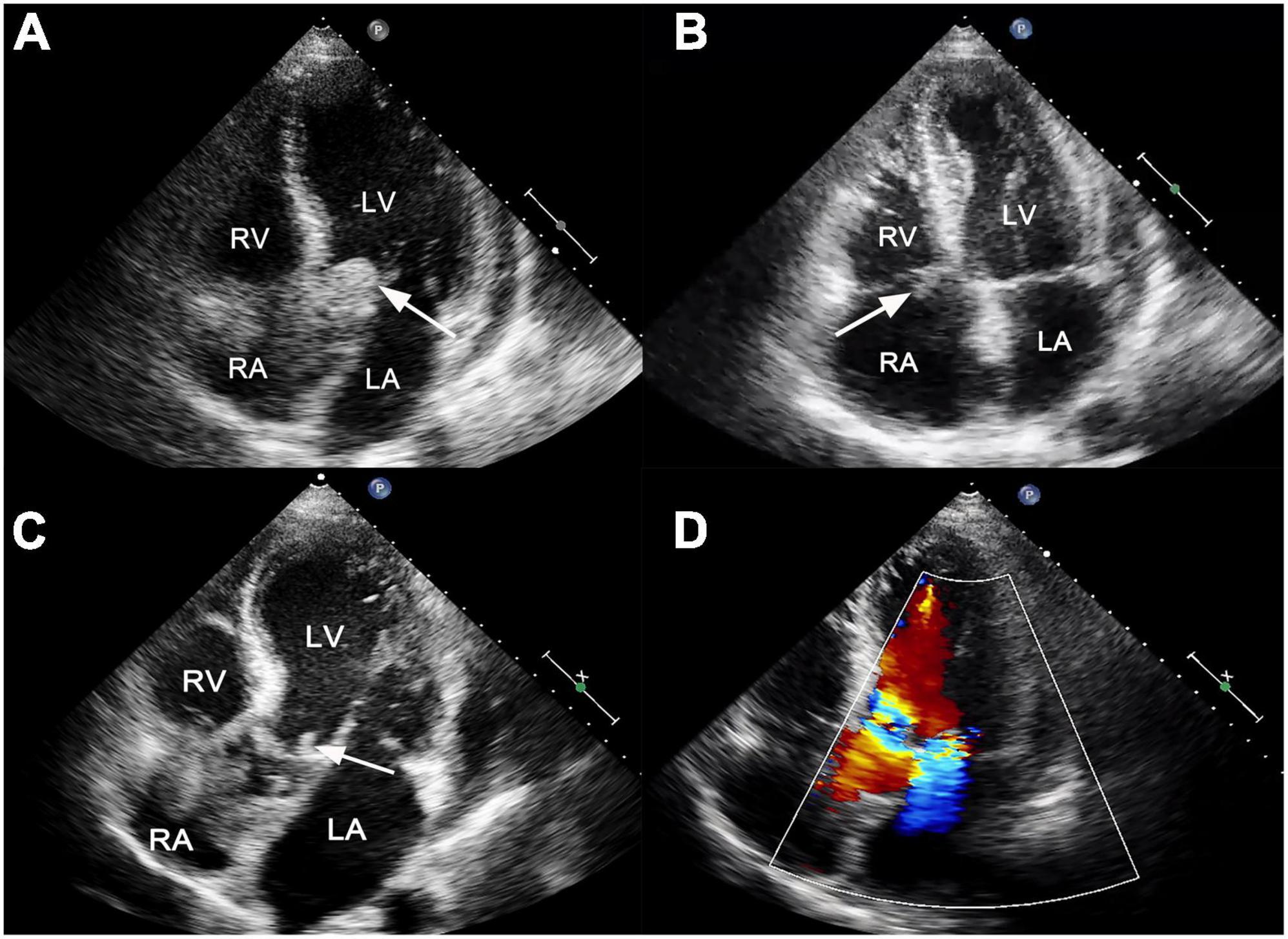 Case report: Fatal systemic embolism caused by early prosthetic valve endocarditis after Bentall surgery